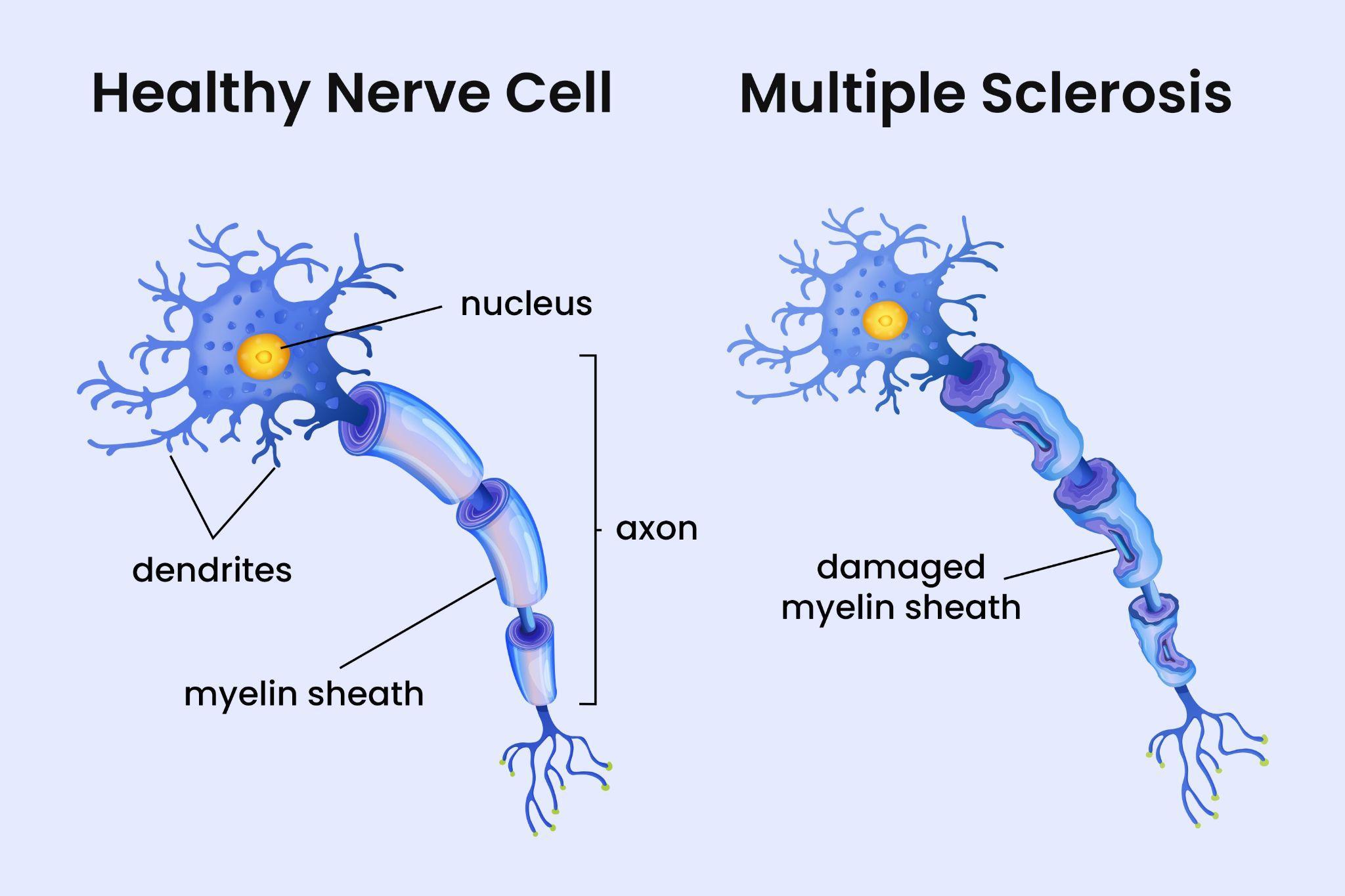 Comparison of a healthy nerve cell and a nerve cell with a damaged myelin sheath in multiple sclerosis